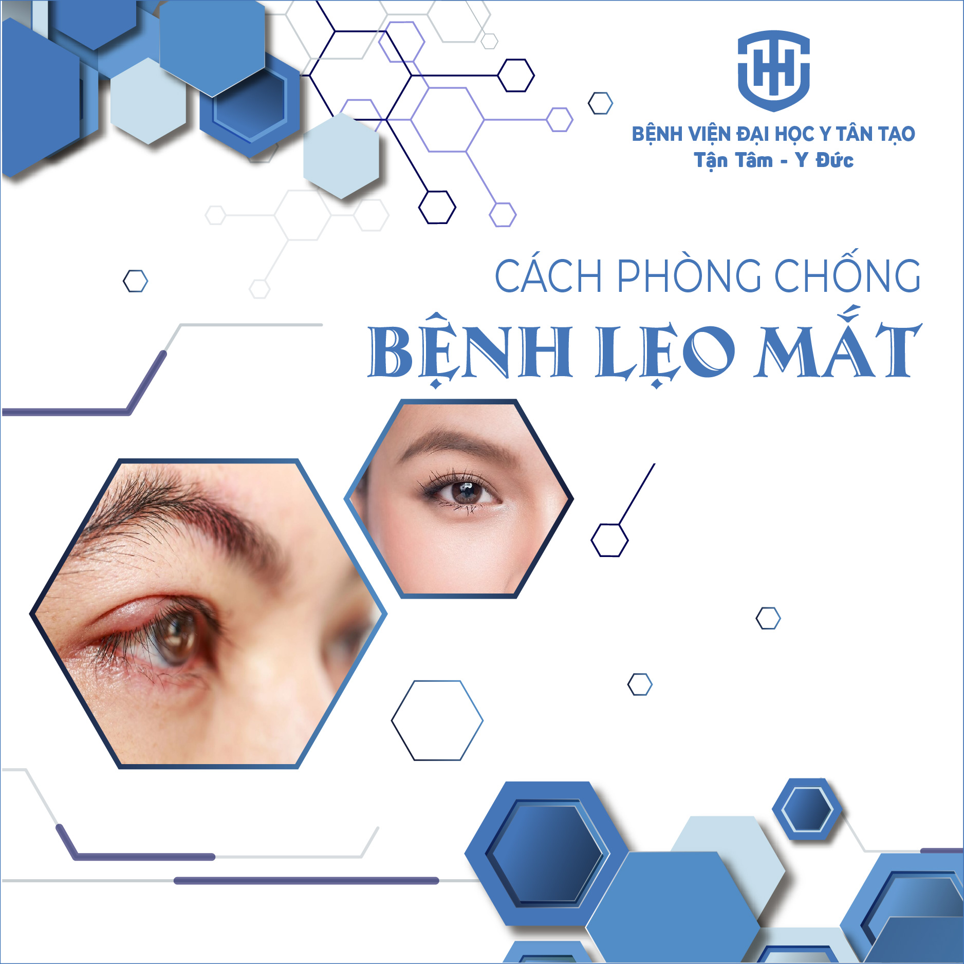 CÁCH PHÒNG NGỪA BỆNH CHẮP LẸO Ở MẮT.