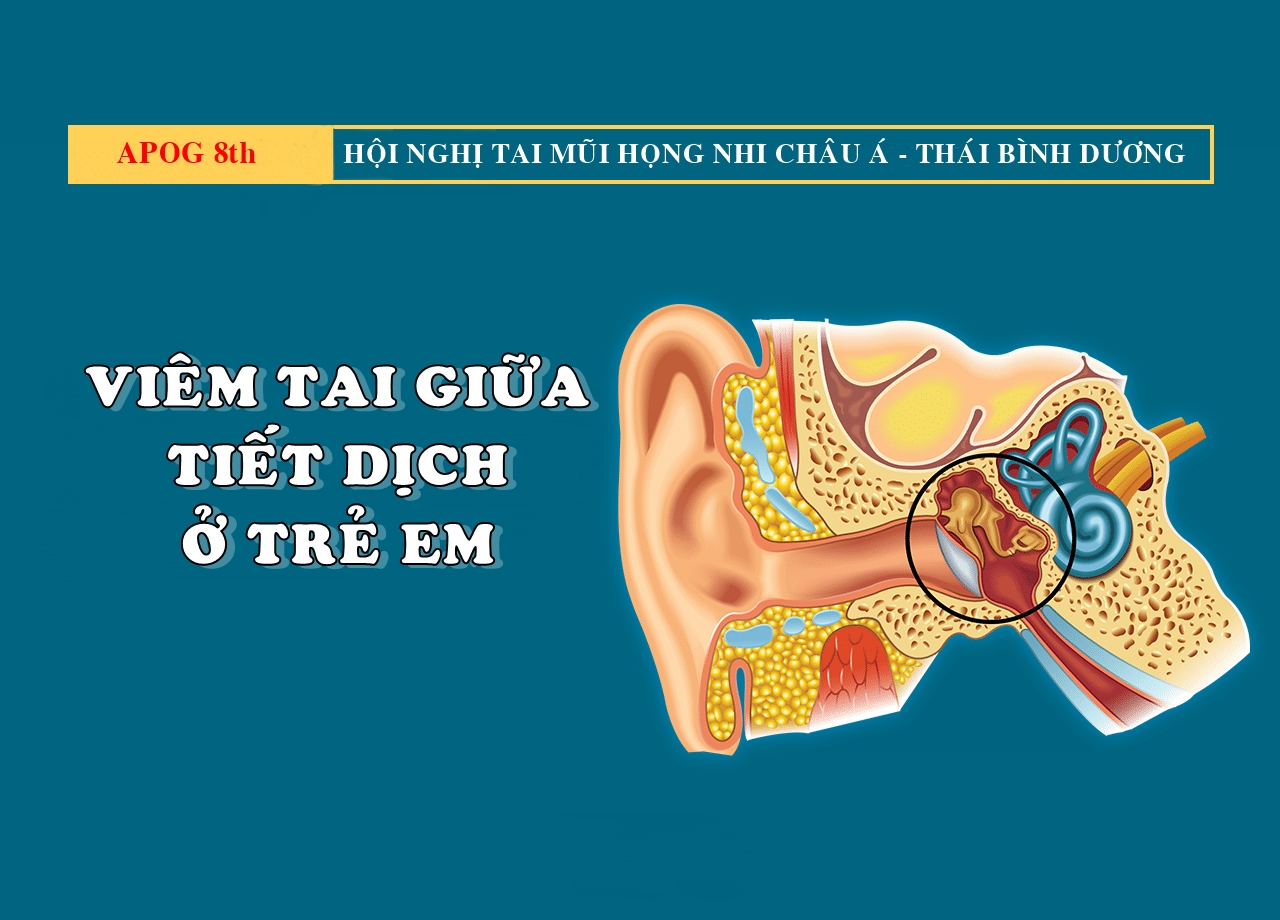 Viêm tai giữa tiết dịch ở trẻ em: Đánh giá hiệu quả thăm dò chức năng ...