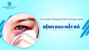 cách phòng ngừa bệnh đau mắt đỏ - avt