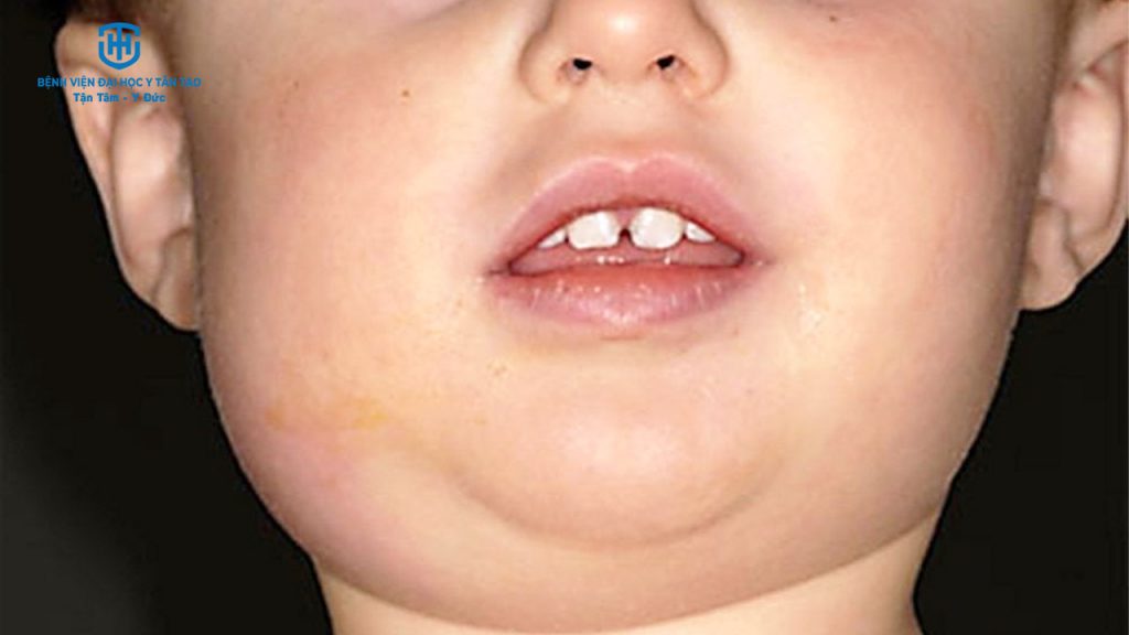 10 bệnh lý phổ biến ở trẻ em vào mùa đông - quai bị