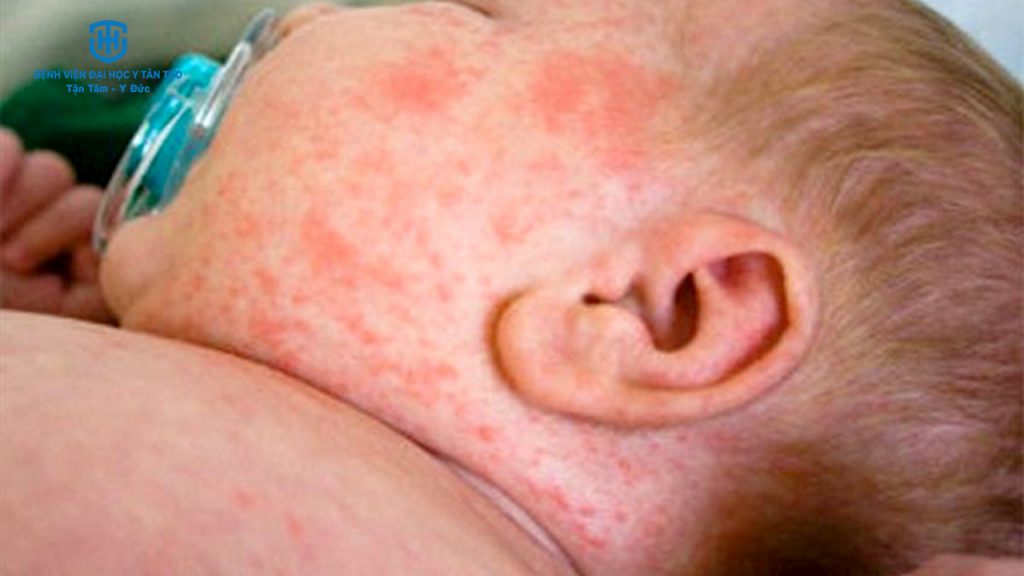 10 bệnh lý phổ biến ở trẻ em vào mùa đông - sốt phát ban