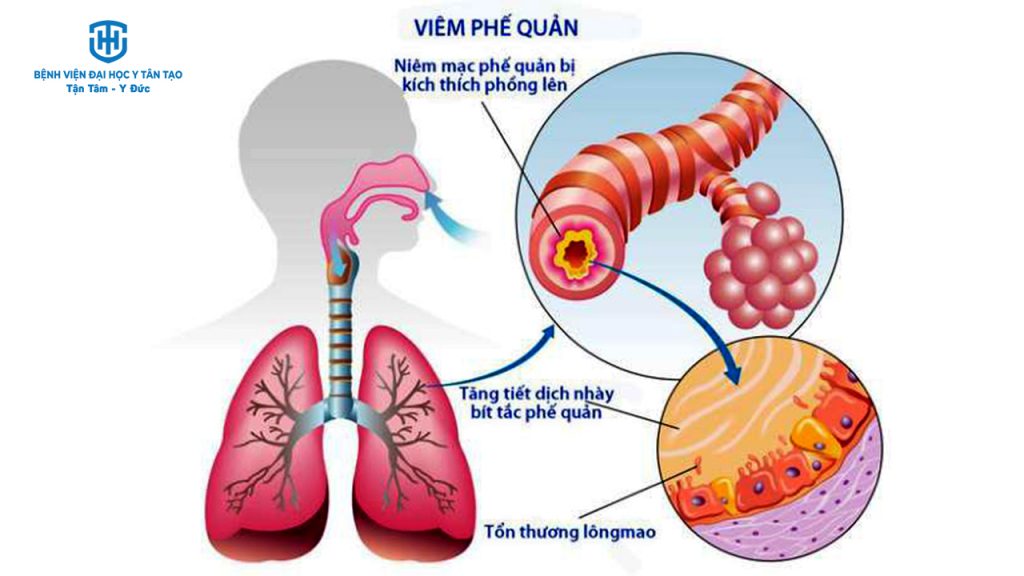 6 bệnh về đường hô hấp thường gặp - viêm phế quản