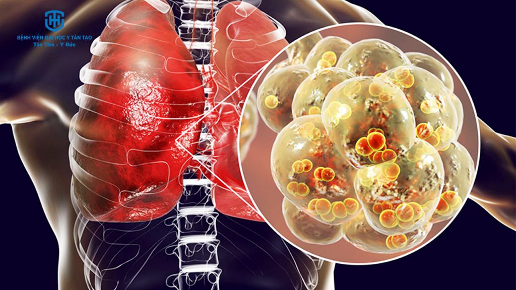 6 bệnh về đường hô hấp thường gặp - viêm phổi