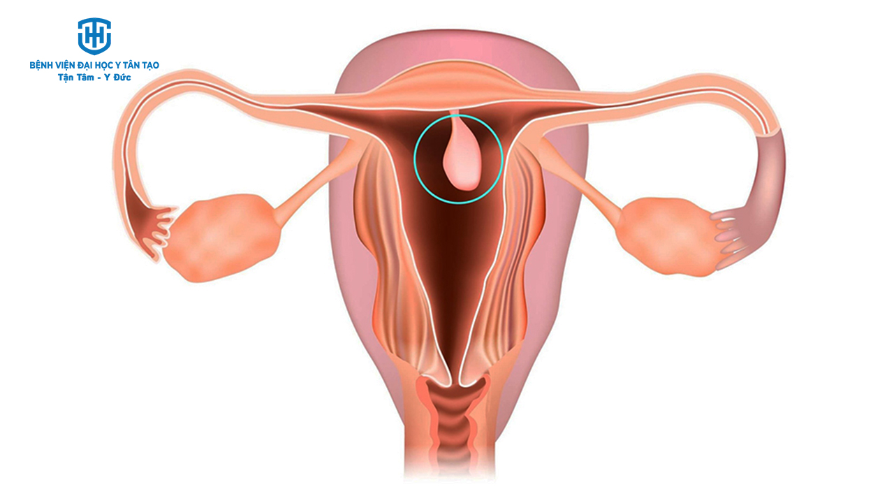 top 9 bệnh lý phụ khoa phổ biến - polyp cổ tử cung