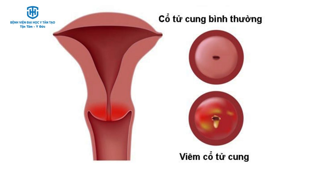 top 9 bệnh lý phụ khoa phổ biến - viêm cổ tử cung