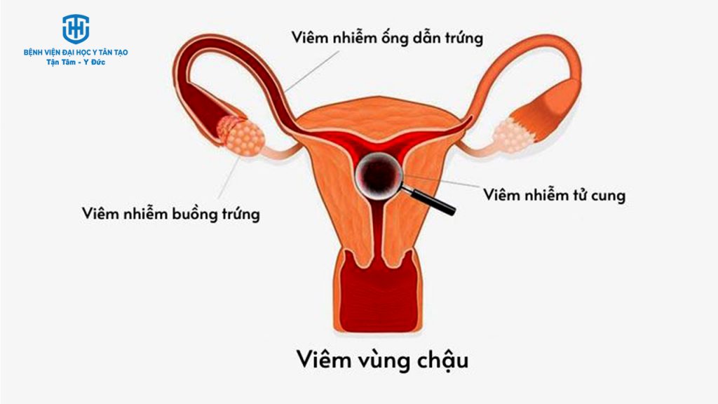 top 9 bệnh lý phụ khoa phổ biến - viêm vùng chậu