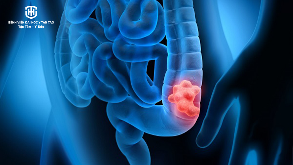 kinh nghiệm đi khám tầm soát ung thư - ung thư đại tràng