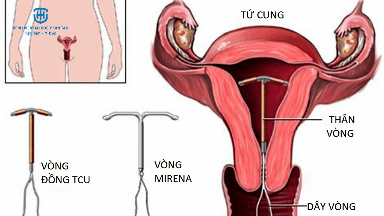 các biện pháp tránh thai - đặt vòng