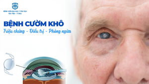 bệnh cườm khô