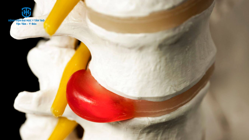 thoát vị đĩa đệm mất bao lâu để lành - đĩa đệm là gì