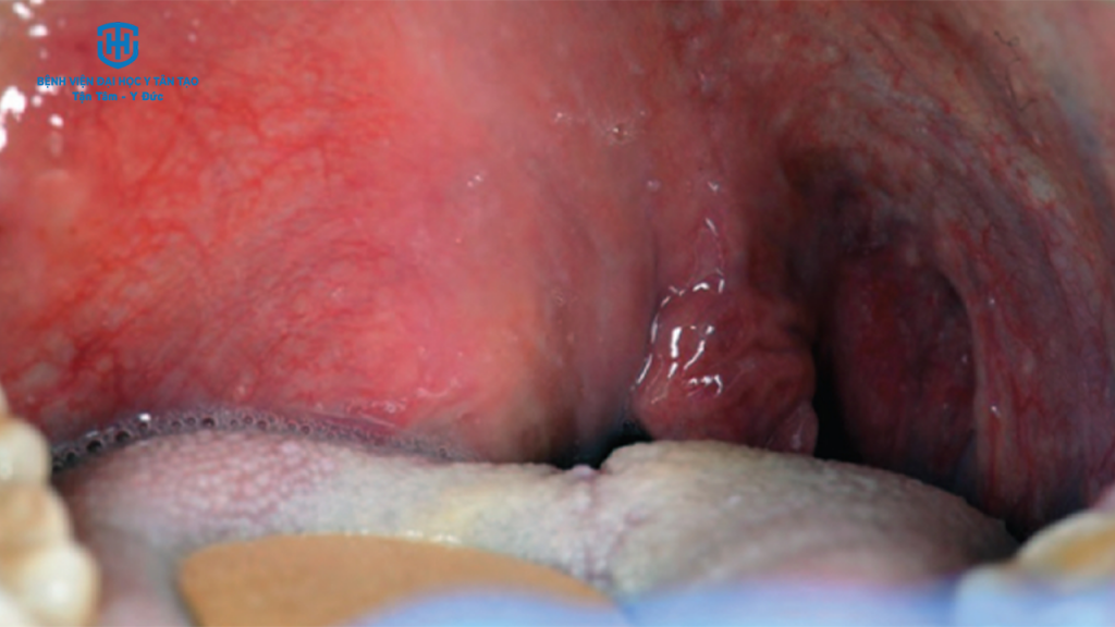 viêm họng do liên cầu khuẩn - biến chứng áp xe quanh amidan