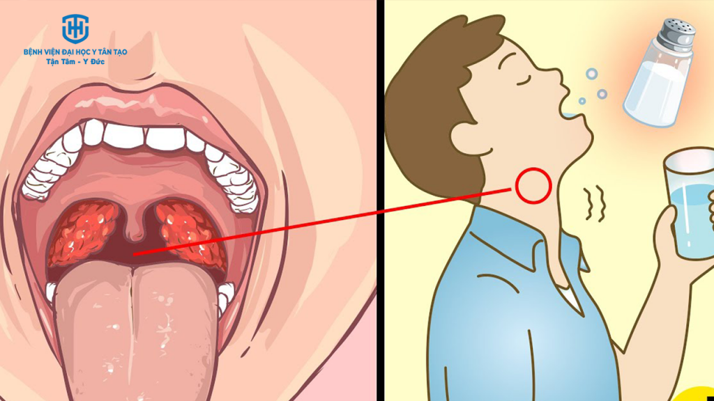 viêm họng do liên cầu khuẩn - điều trị tại nhà
