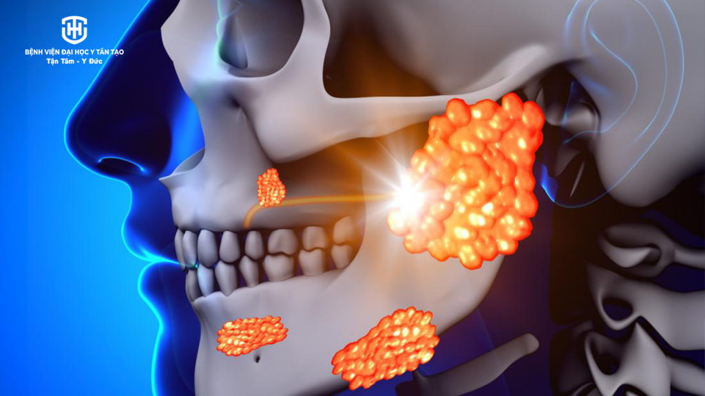 bệnh quai bị - triệu chứng