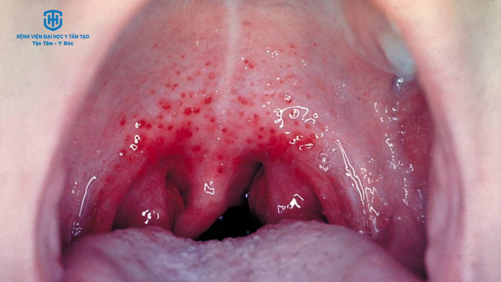 triệu chứng viêm họng do liên cầu khuẩn