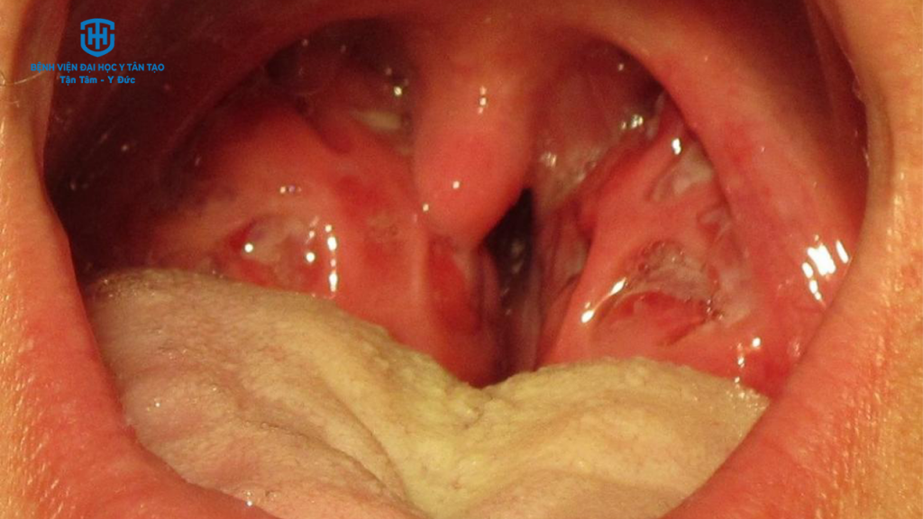 triệu chứng viêm họng do liên cầu khuẩn