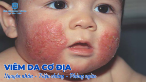 viêm da cơ địa