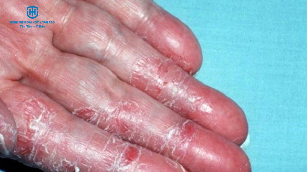 viêm da cơ địa - ở người lớn