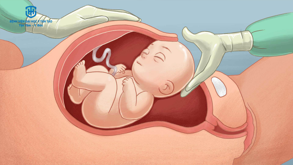 khi nào thì sinh mổ - sinh mổ là gì