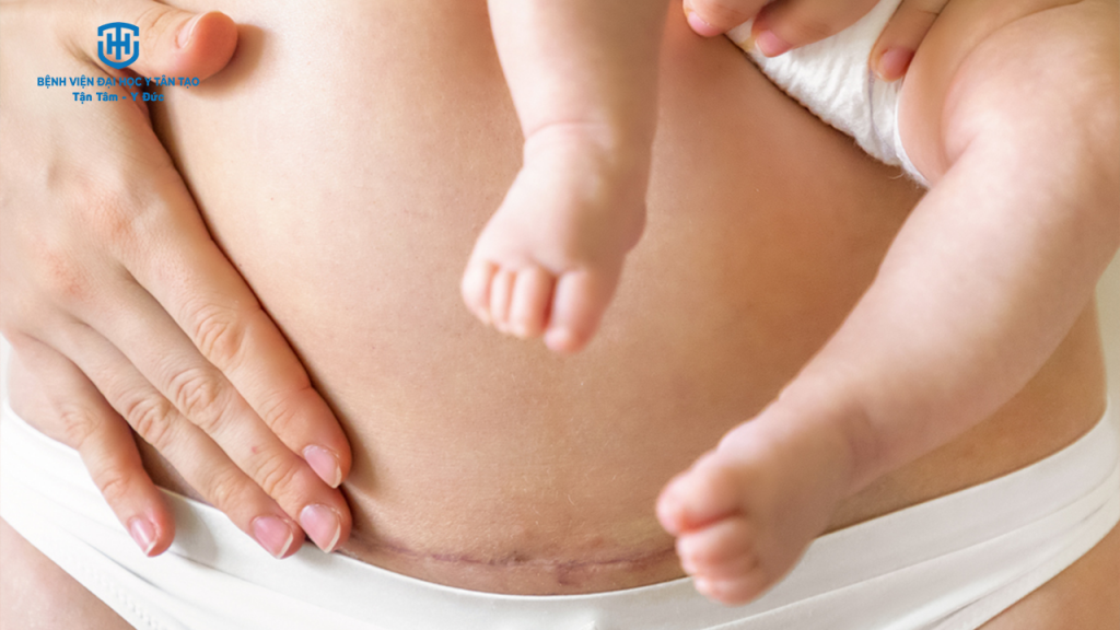 khi nào thì sinh mổ - trường hợp sinh mổ