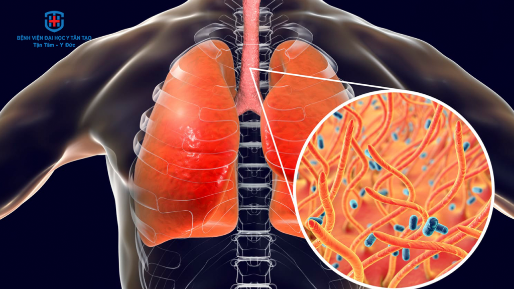 ho gà - nguyên nhân