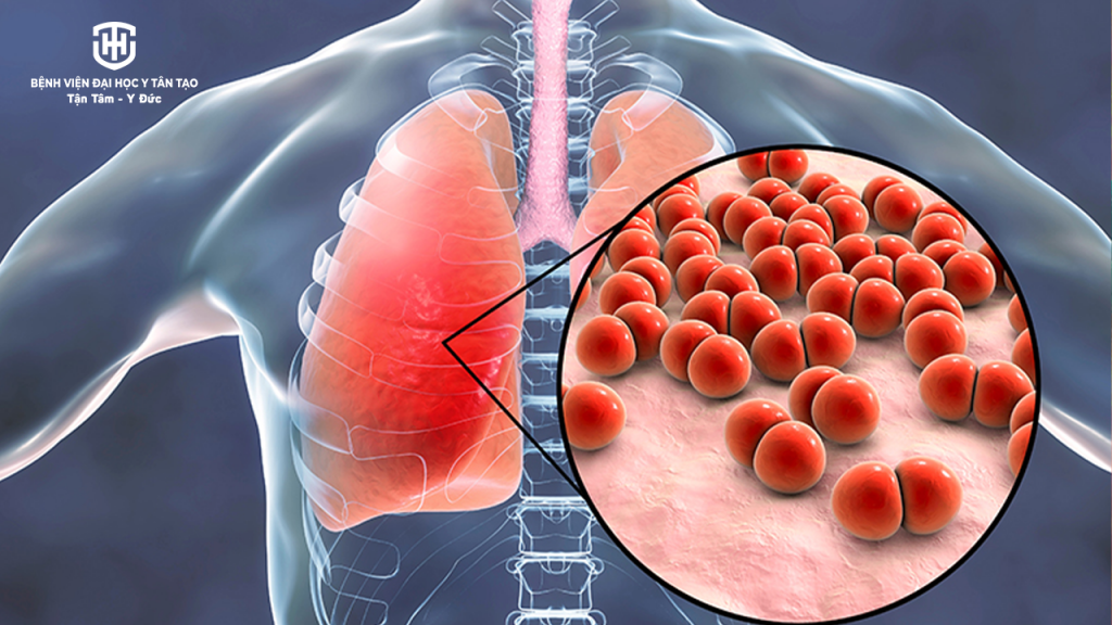 synflorix vắc xin ngừa phế cầu - phế cầu khuẩn gây ra những bệnh gì