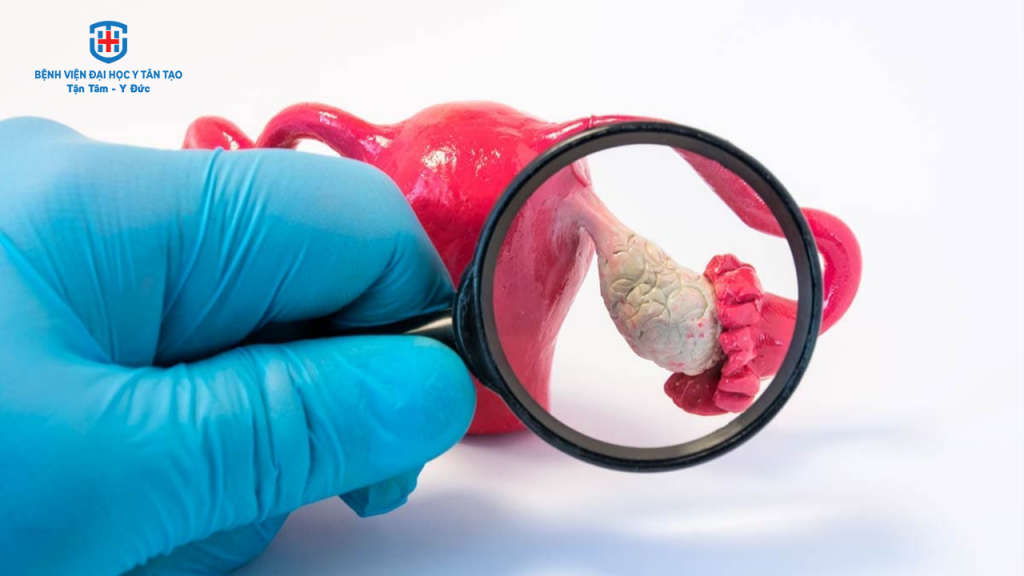 chậm kinh nhưng không có dấu hiệu mang thai - do suy buồn trứng sớm