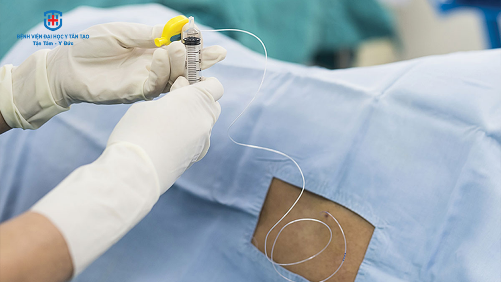 gây tê ngoài màng cứng - ống catheter