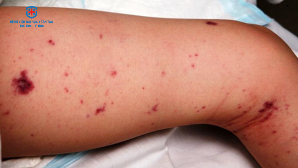 viêm màng não mô cầu BC - triệu chứng tử ban