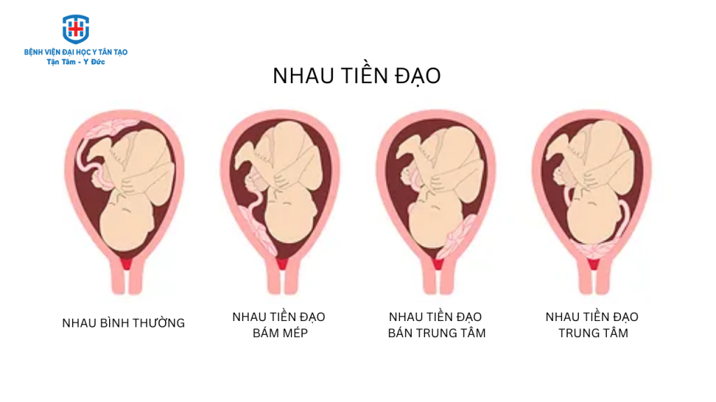 các vấn đề về nhau thai - nhau tiền đạo